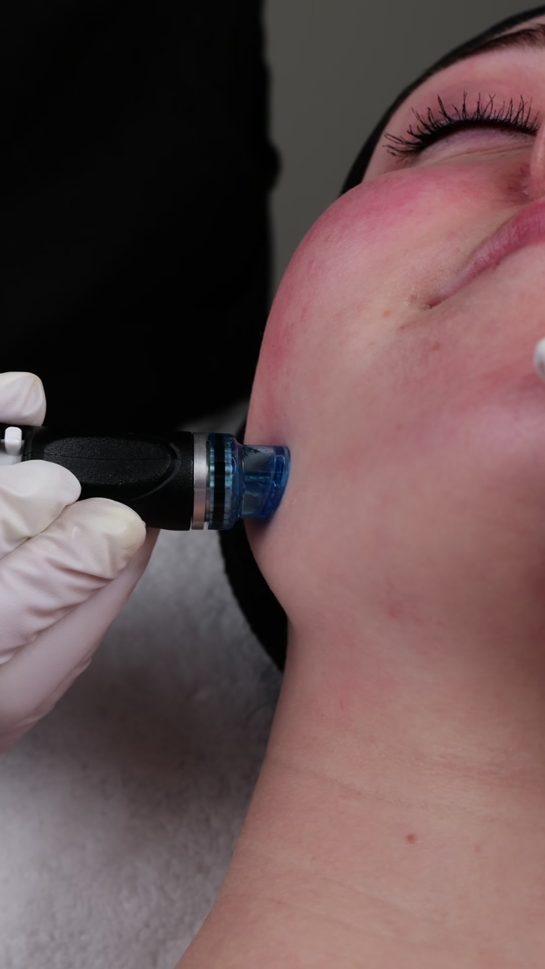 HydraFacial hudstruktur förbättring hos Hudsalong Anna Maria Huskvarna